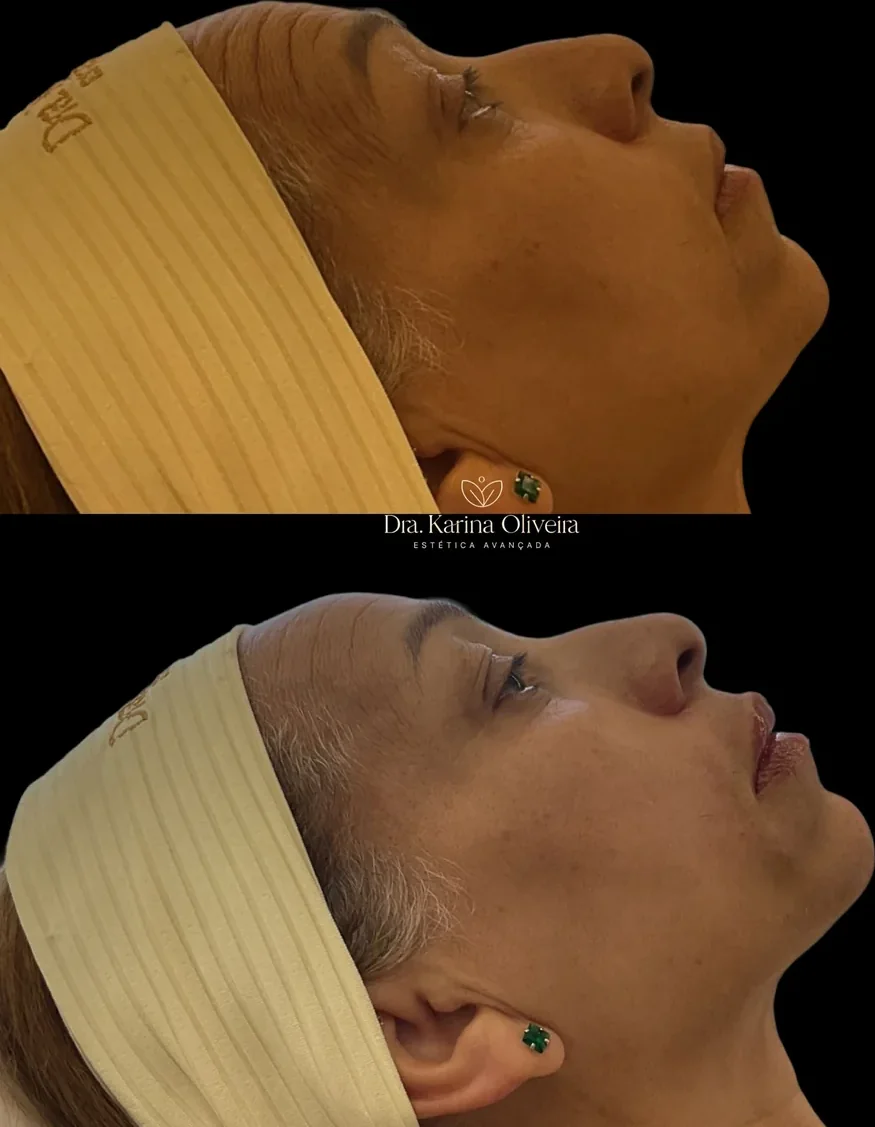 Antes e depois de perfiloplastia sem cirurgia, paciente real da Dra. Karina Oliveira