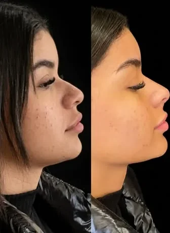 Antes e depois de rinomodelação sem cirurgia, paciente real